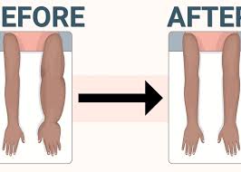آلية تقييم حالة استئصال الثدي في العلاج الطبيعي