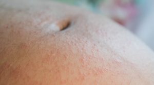 أبرز أشكال الحساسية الجلدية الشائعة في الحمل