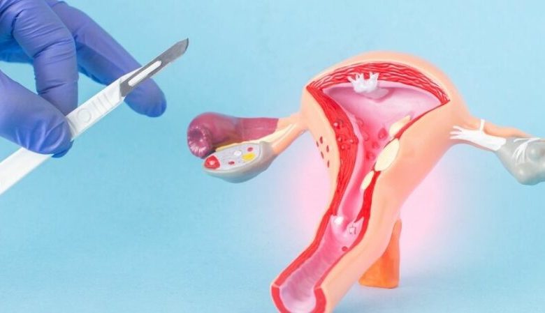 أبرز المضاعفات التي يسببها استئصال الرحم