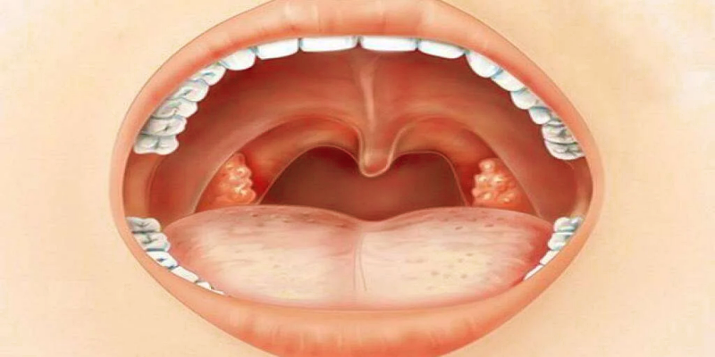 أسباب تكرار الاصابة بالتهاب اللوزتين
