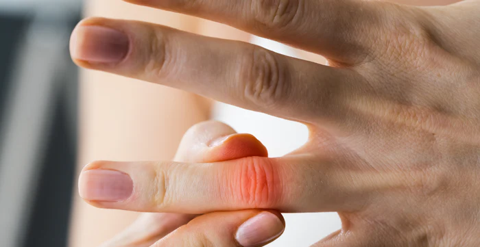 إسمرار مفاصل الأصابع