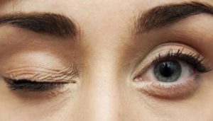 ارتعاش عضلات الجفون