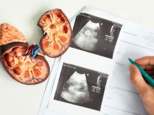 الأسباب المحتملة لتكيس الكلى