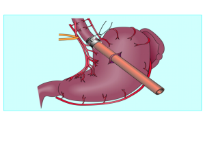 الأسباب المحتملة لدوالي المرىء