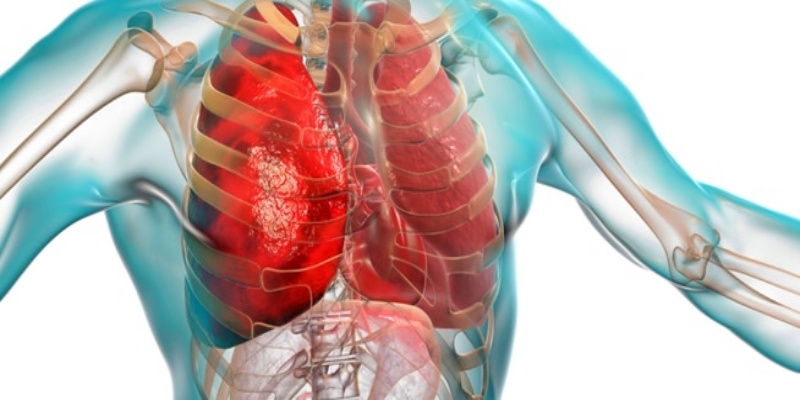 الالتهاب الرئوي المزمن