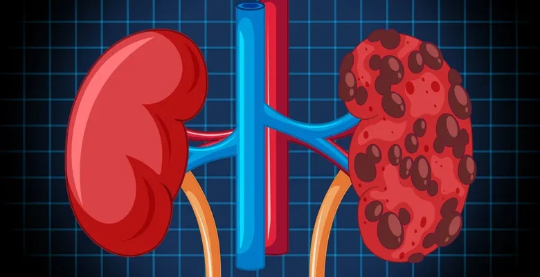 التكيس الكلوي