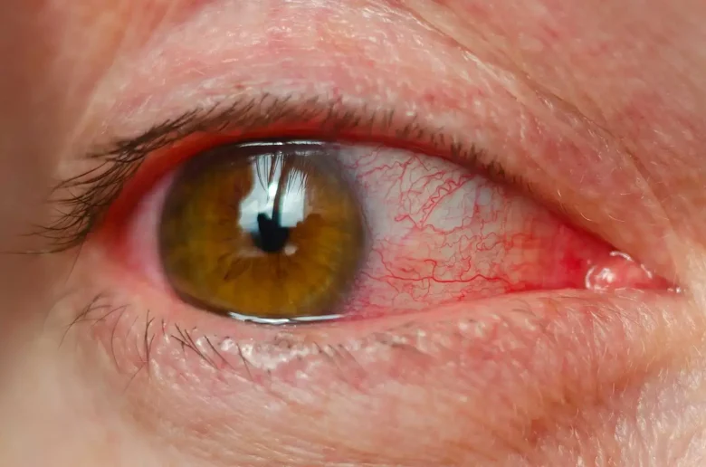 التهاب باطن العين