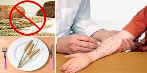 الحساسية الغذائية