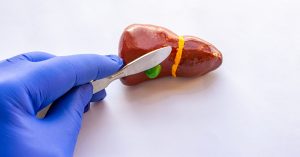 العلاقة بين جراحة المرارة والإمساك