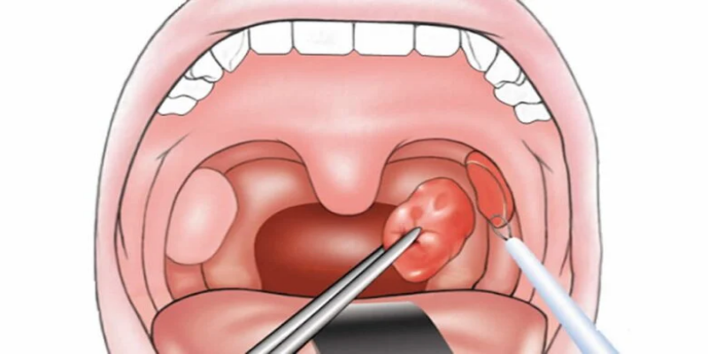 الوقت الأنسب لإستئصال اللوزتين