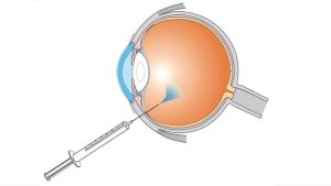 تشخيص التهاب باطن العين