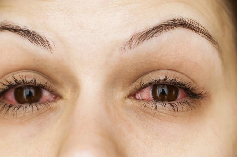 تورم العين الناجم  عن الحساسية