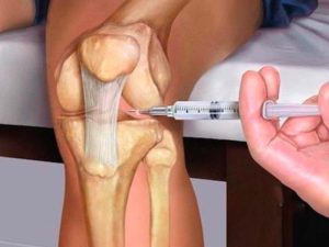 حقنة الجيلاتين أم حقنة البلازما لعلاج الخشونة