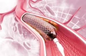 حول تركيب دعامات القلب