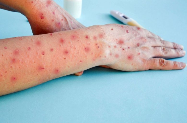 خضراوات مفيدة لجدري الماء