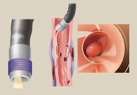 ربط دوالي المرىء بالمنظار