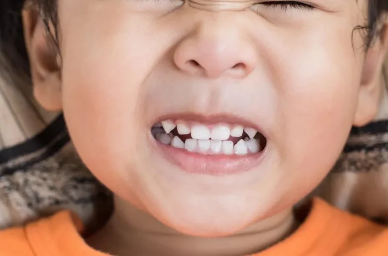 صرير الأسنان لدى أطفال التوحد