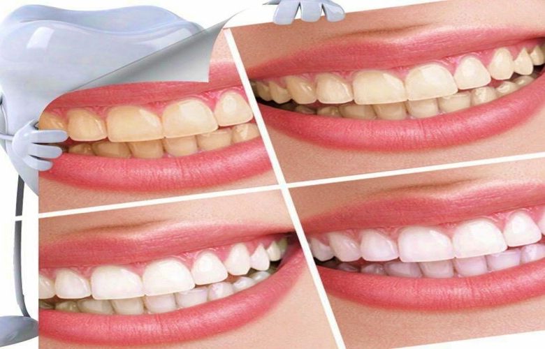 طرق بسيطة لتبييض الأسنان والحصول على نفس منعش