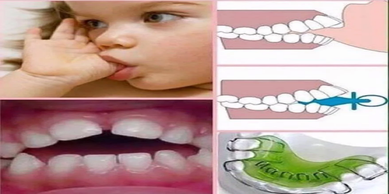 عواقب عادة مص الأصابع عند الأطفال على الأسنان والوجه
