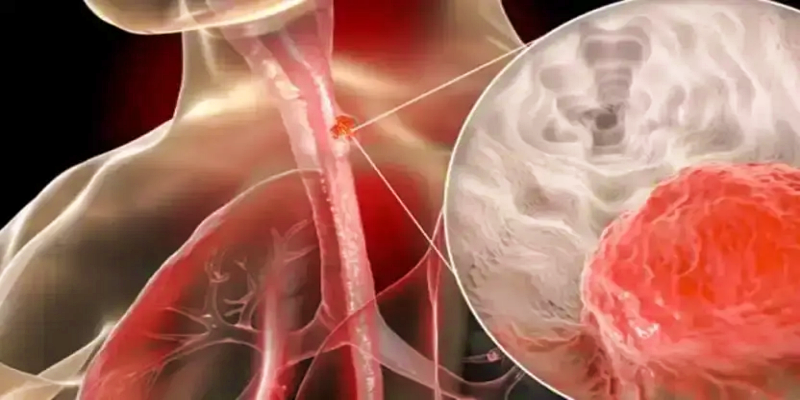 ما العلاقة بين مشاعر الاختناق وبعض الحالات المرضية الخطيرة؟