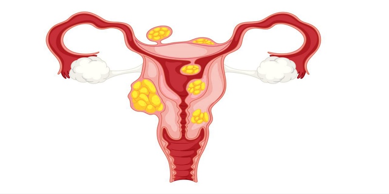 ما المقصود بالأورام الليفية الرحمية؟