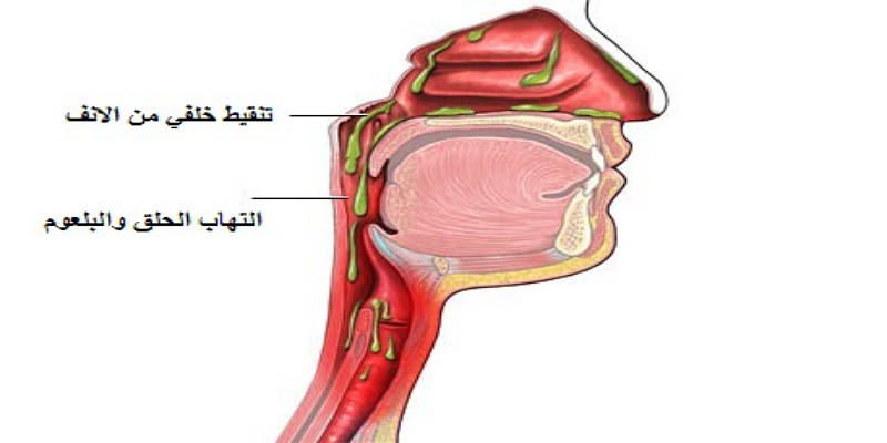 ما المقصود بمتلازمة الإفرازات الأنفية الخلفية؟