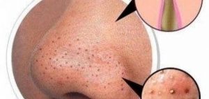 ماهي الأعراض الشائعة لحب الشباب لدى المدخنين ؟