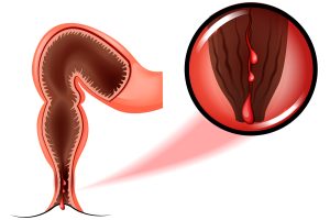 ماهي الأنماط الشائعة من المضاعفات ذات الصلة بداء كرون ؟