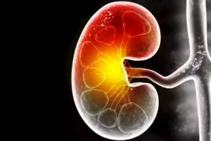 مرض الكلى المزمن