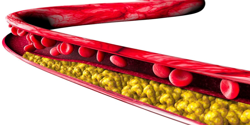 مرضى ارتفاع الدهون الثلاثية في الدم
