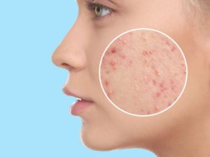 نبذة عن أبرز مسببات حب الشباب