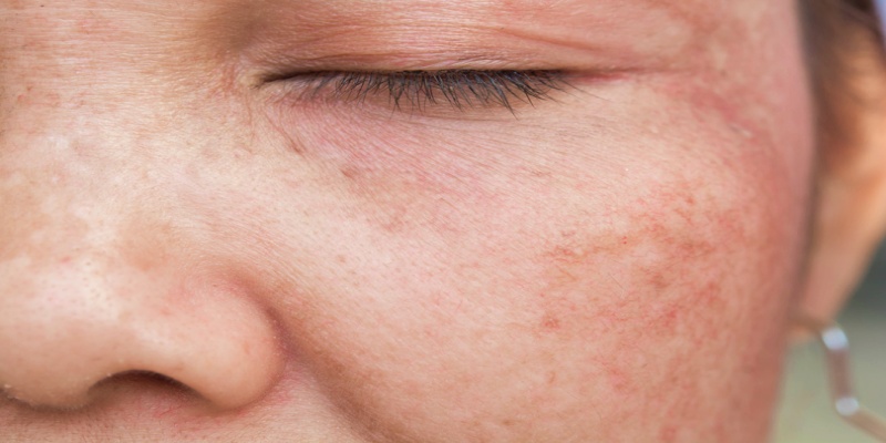 هل ترتبط البقع العمرية بمخاطر الإصابة بأورام الجلد سرطانية؟