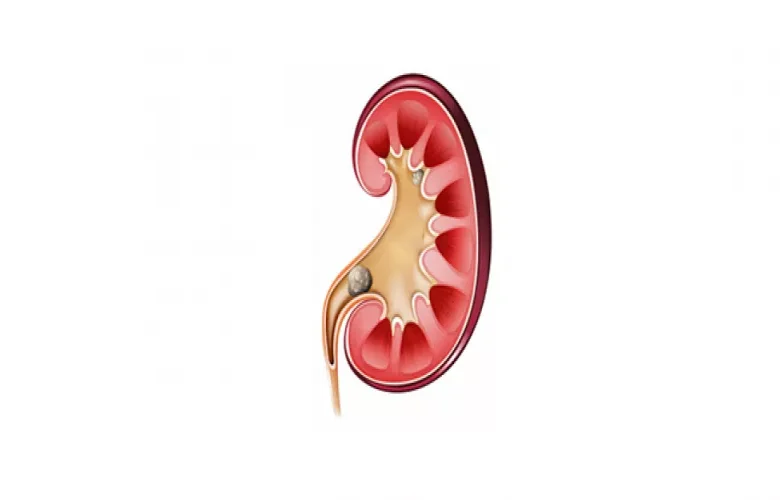 5 أسباب تؤدي إلى زيادة فرص الإصابة بحصوات الحالب