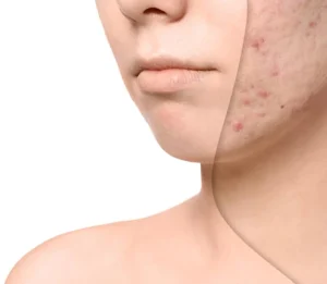 أبرز العلاجات الفعالة لمكافحة ندبات حب الشباب