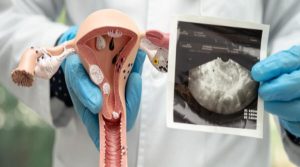 أبرز النصائح المتبعة عند تمزق أكياس المبيض