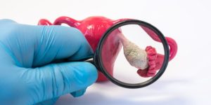 أسباب تمزق كيس المبيض لدى النساء