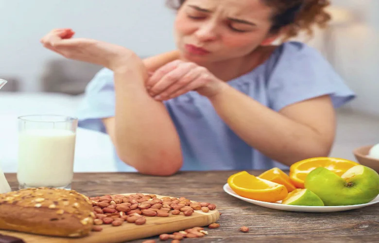 أطعمة يجب تجنبها عند المعاناة من الإكزيما