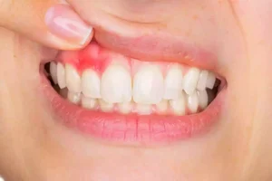 أعراض انحسار اللثة