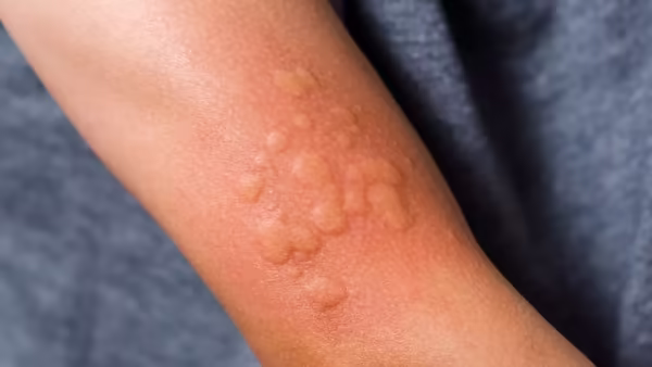 أعراض حساسية الثوم