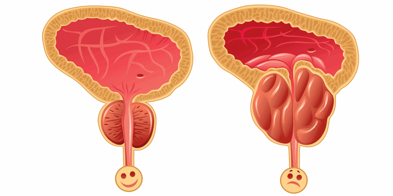 أمراض البروستاتا والإحليل