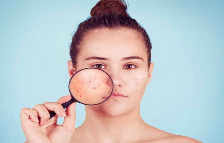 أهم العادات السيئة التي تؤدي إلى ظهور حب الشباب