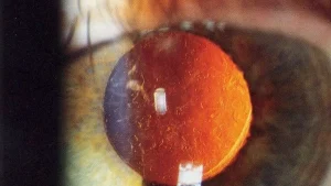 إعتام عدسة العين الثانوي