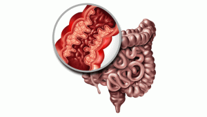 الإنسداد المعوي