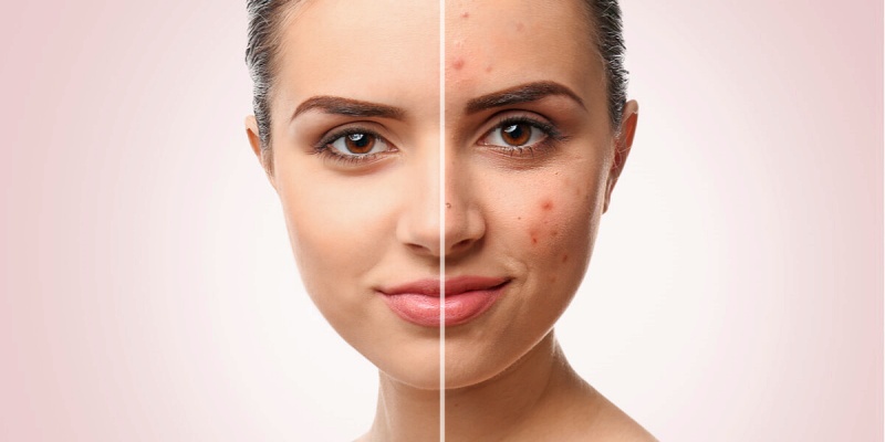 التقليل من حب الشباب