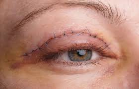 الحلول الجراحية لشد الجفون