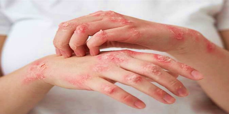 العلامات المبكرة لمرض الإكزيما الجلدي