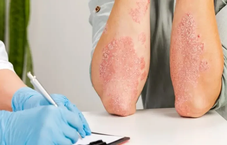 الفطريات الجلدية وكيف يتم التعرف عليها باكرا لتجنب انتشارها؟