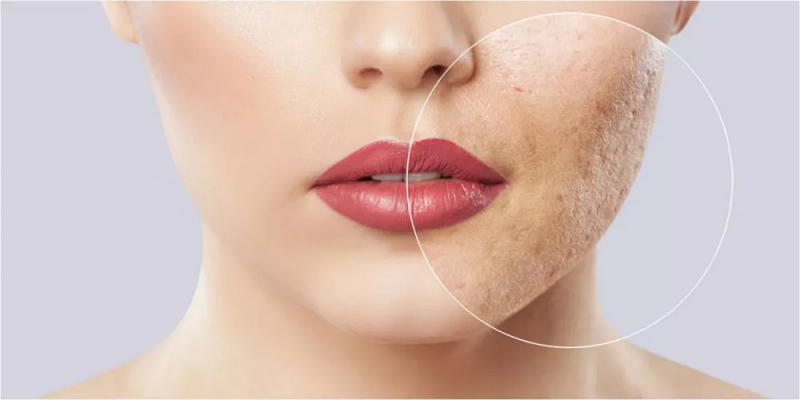 القضاء على آثار حب الشباب