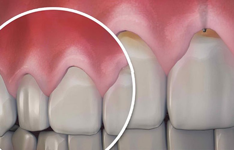 تدابير فعالة لعلاج مشكلة انحسار اللثة
