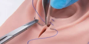 تمزق المهبل أثناء الولادة